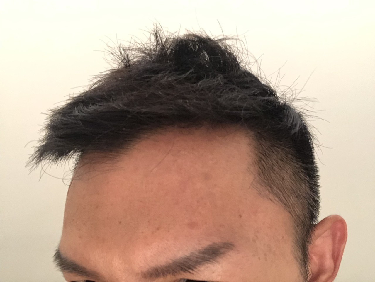 痘痘一直没好?因为你踩到4种地雷 难怪痘痘长不停